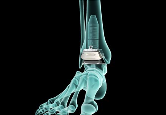 protesi di caviglia