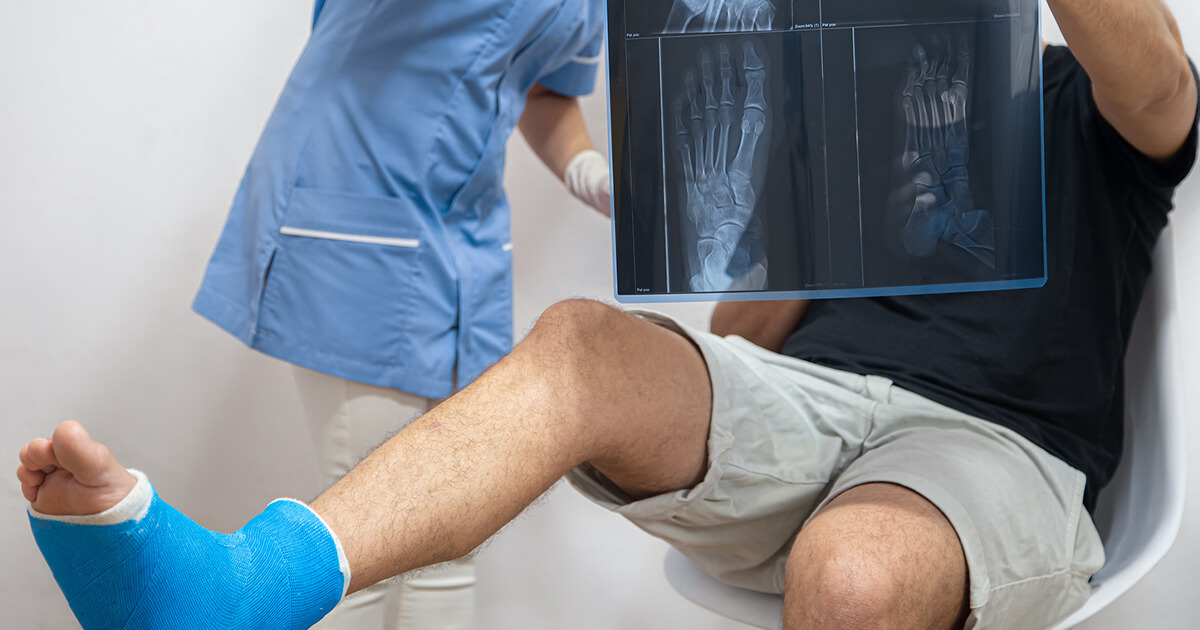 Frattura del piede: sintomi, diagnosi e cura